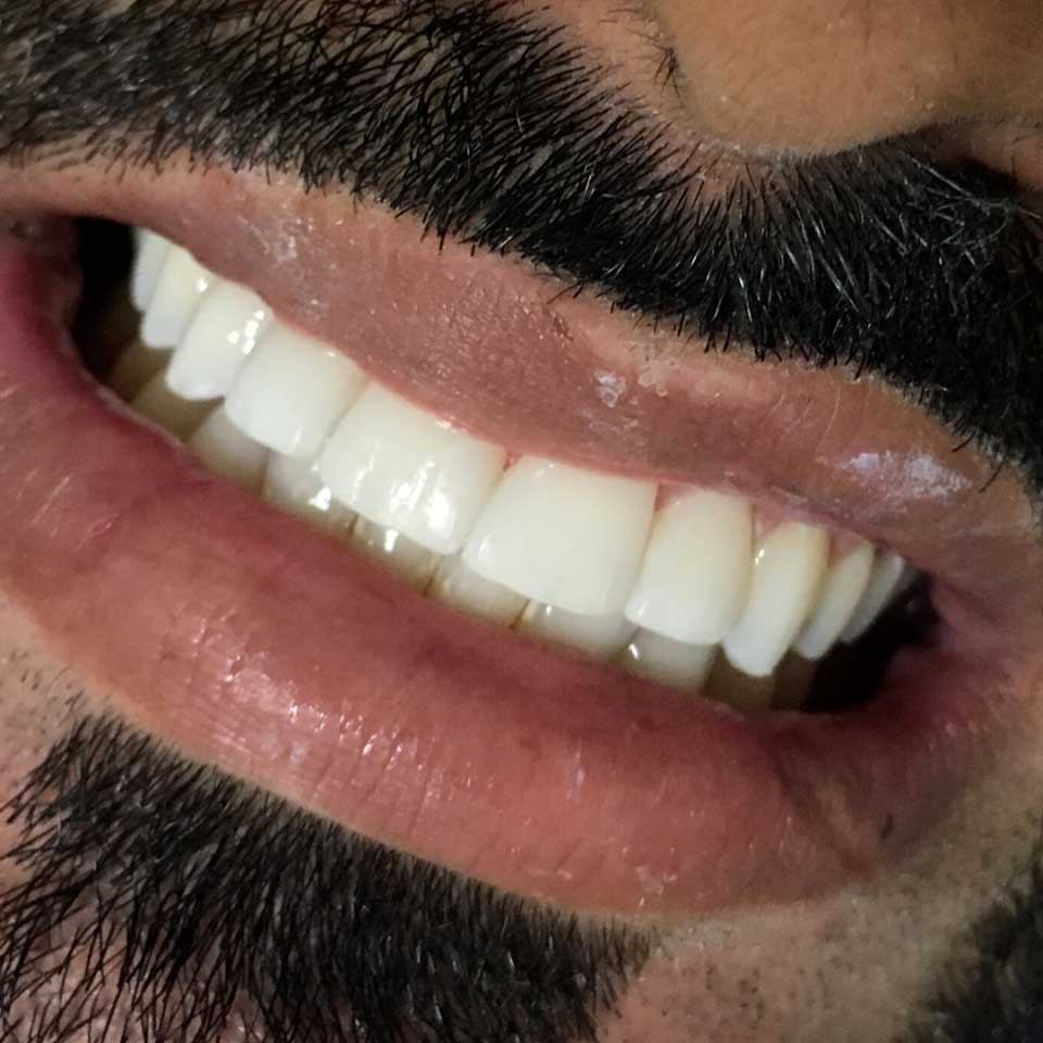 Clareamento Dental